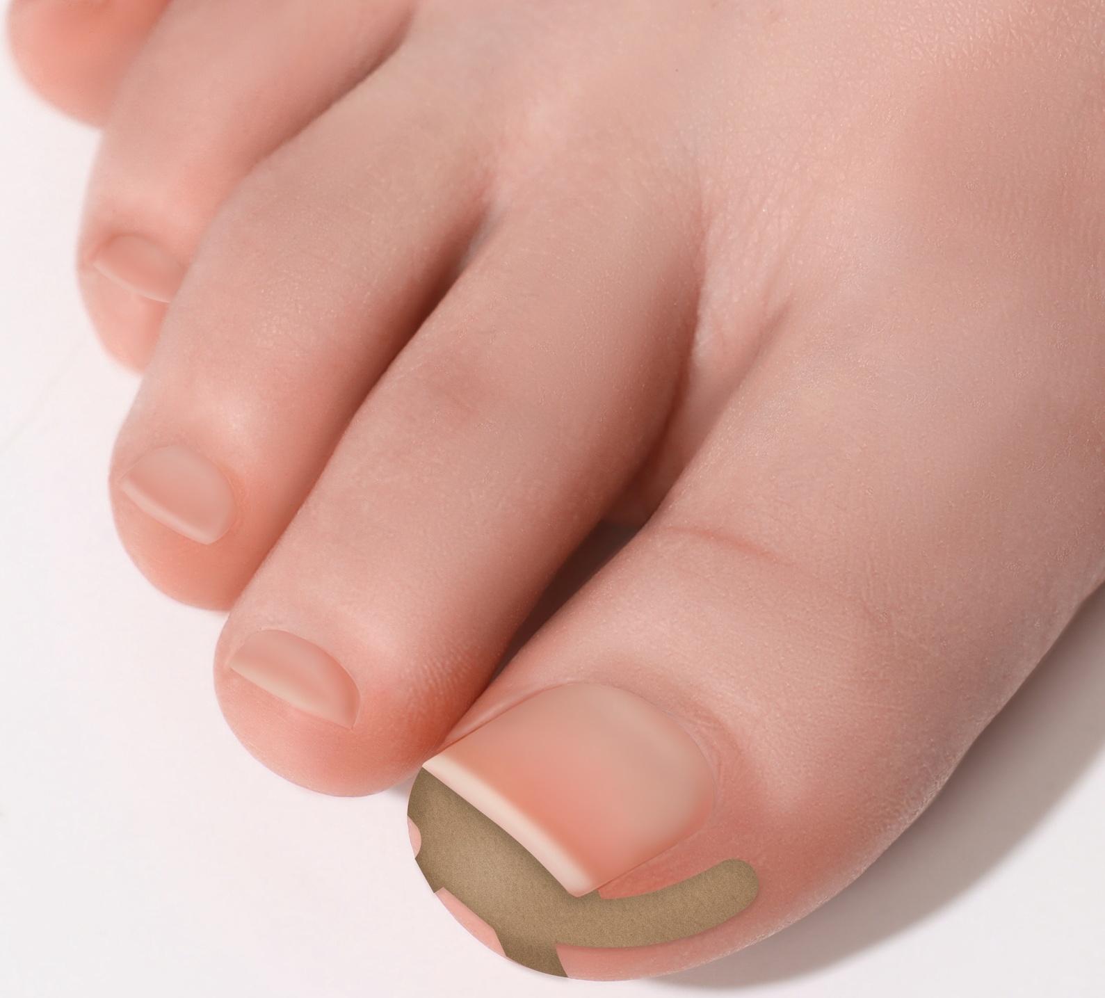 Наклейки против вросших ногтей, 16 шт., бежевые