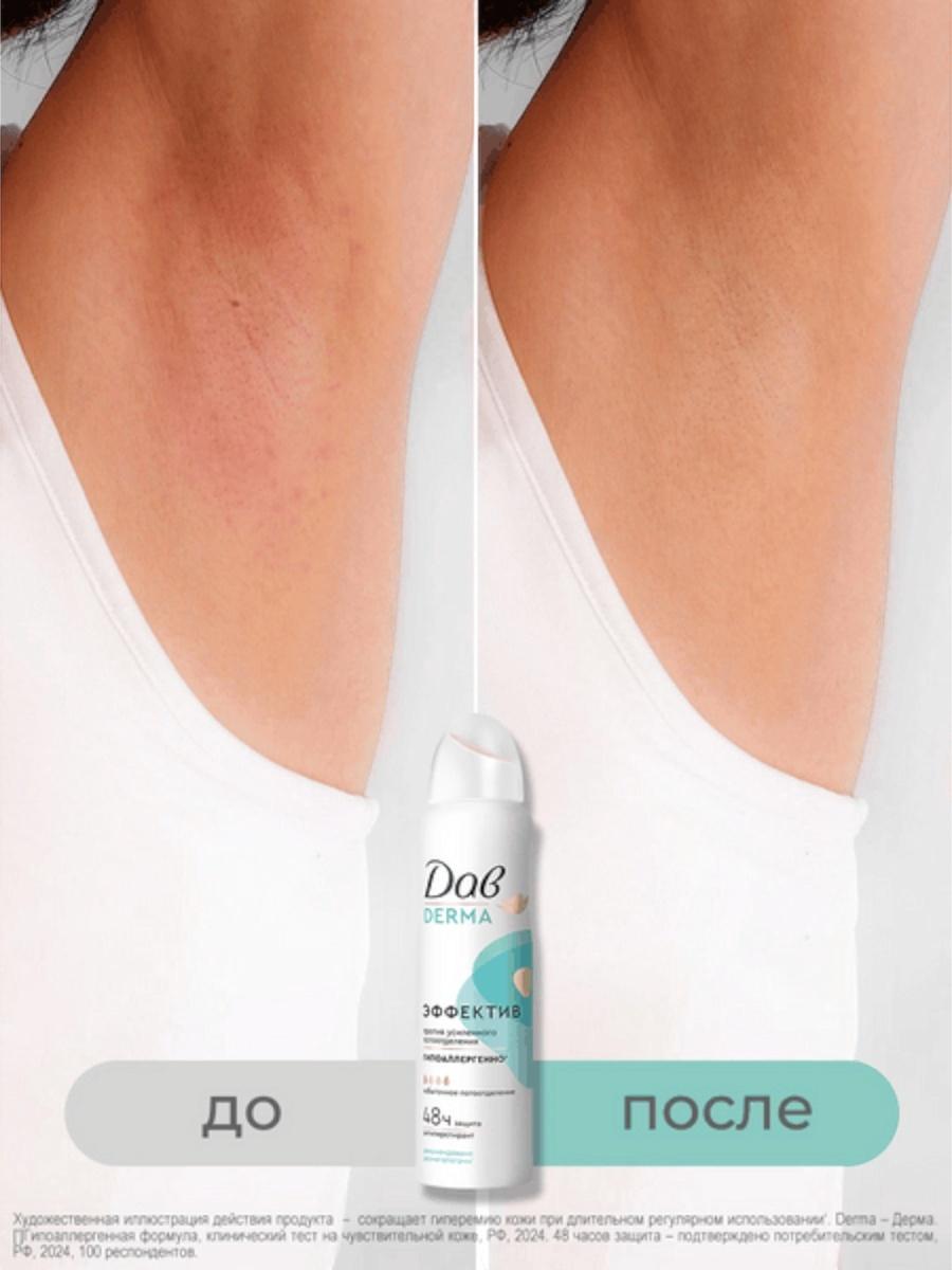 Дезодорант женский «Дав», гипоаллергенный, против сильного пота, 150 мл