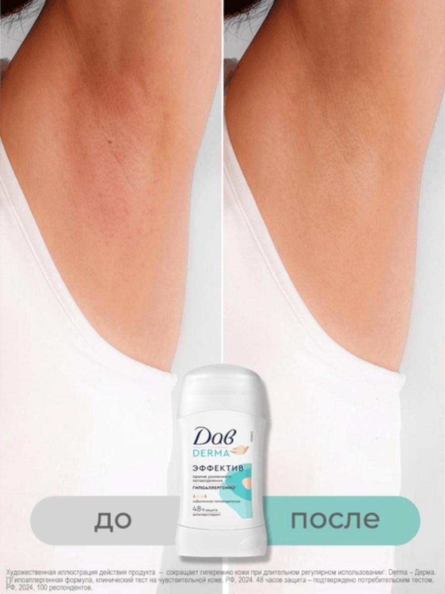 Дезодорант женский «Дав», гипоаллергенный, против сильного пота, 40 мл